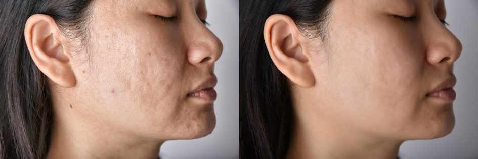 Skin problems and acne scar